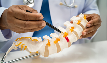 myelopathy