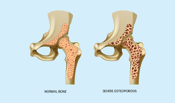osteoporosis