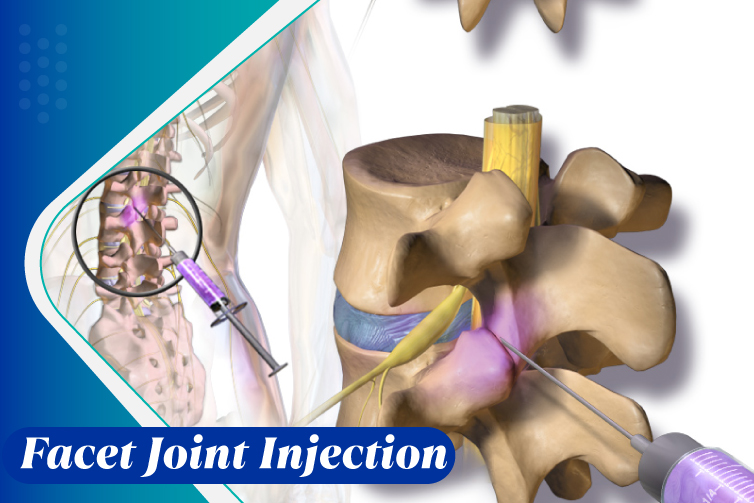 Facet-Joint-Injection