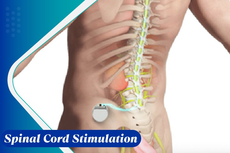 Spinal-Cord-Stimulation