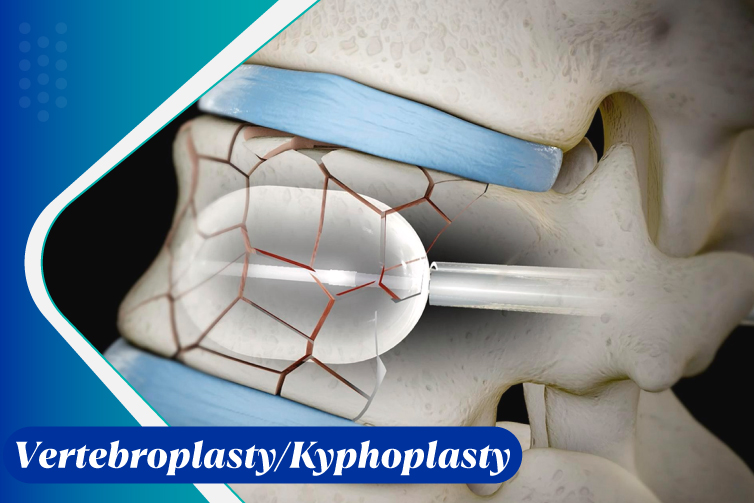 Vertebroplasty Kyphoplasty