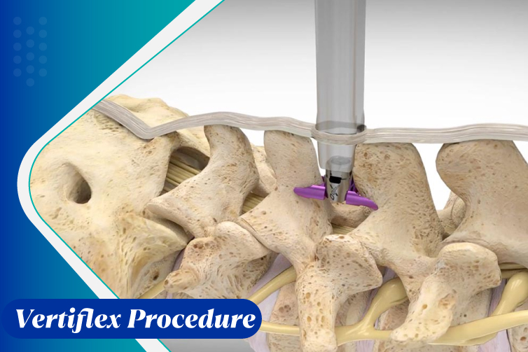 Vertiflex-Procedure