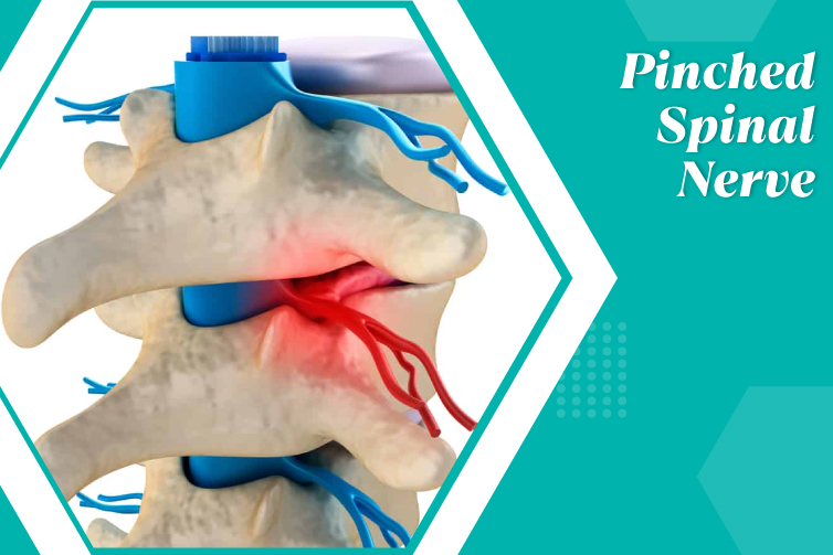 Pinched Spinal Nerve