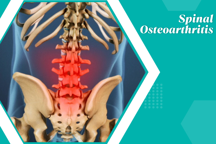 Spinal Osteoarthritis